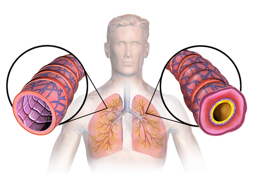 asthma