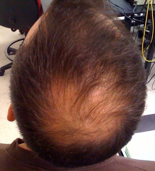 balding