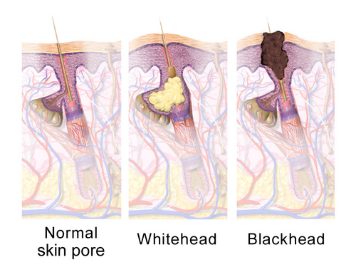 blackhead