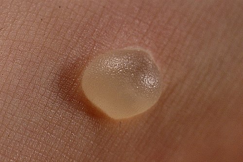blister