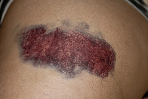 bruise