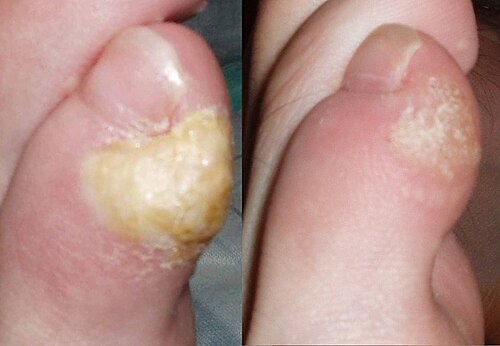 callus