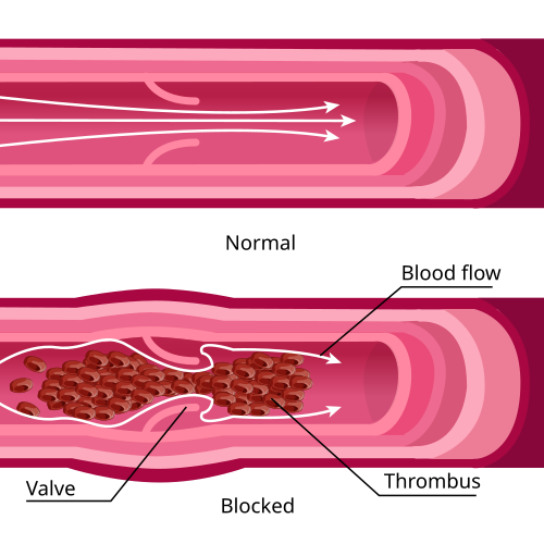 clot