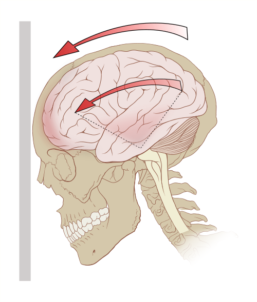 concussion