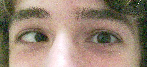 cross-eyed