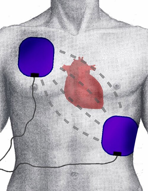 defibrillator