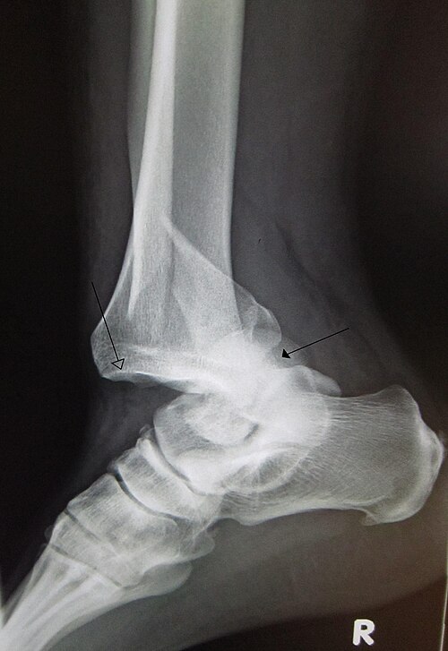 dislocate