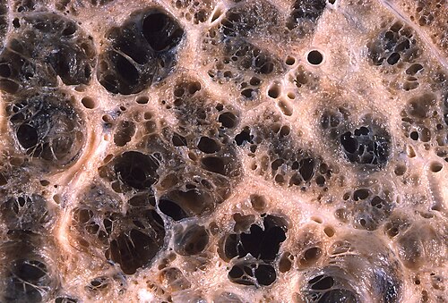 emphysema