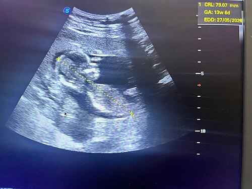 fetus