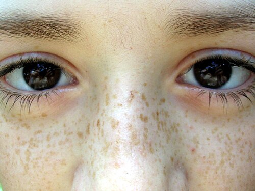 freckle