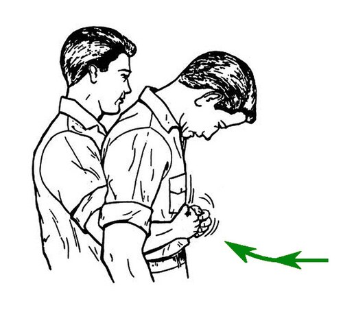 heimlich manoeuvre