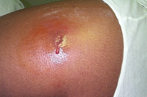 infection