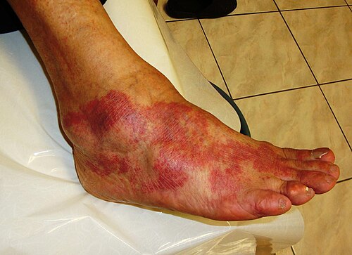 inflammation