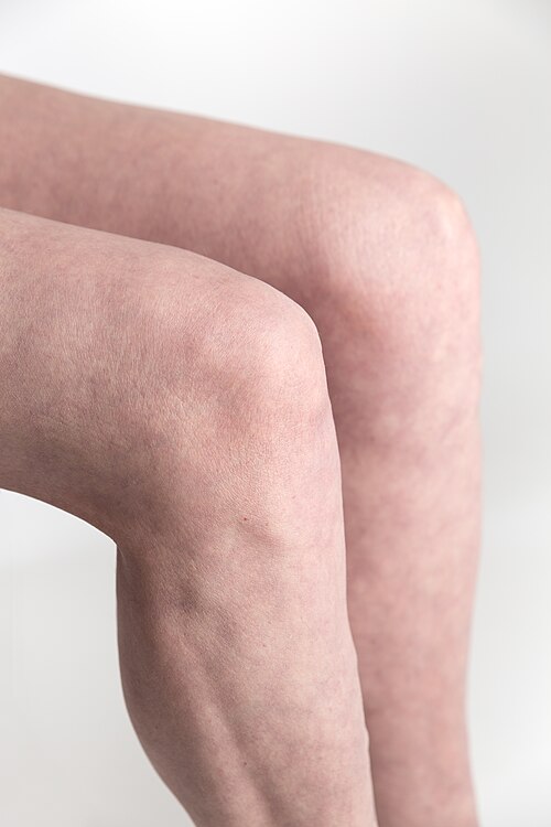 knee