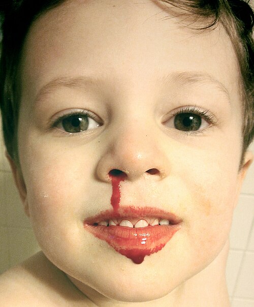 nosebleed