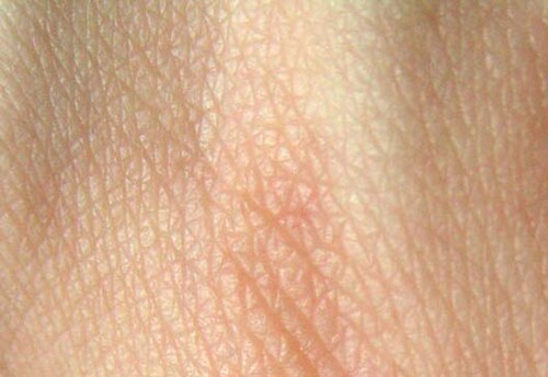 oily skin