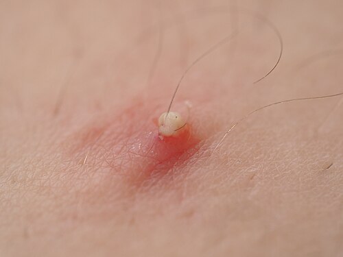 pimple