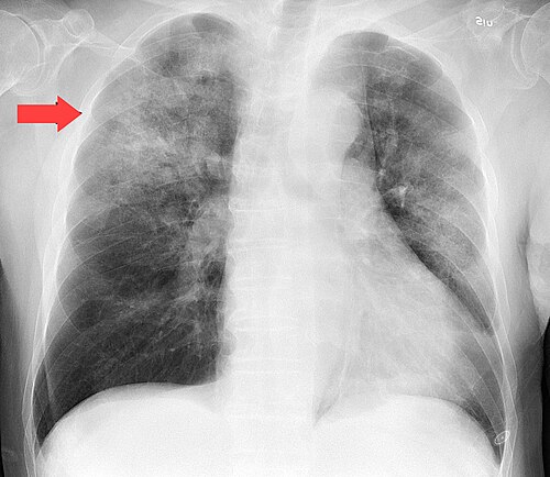 pneumonia