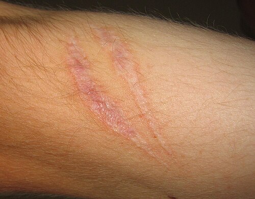 scar
