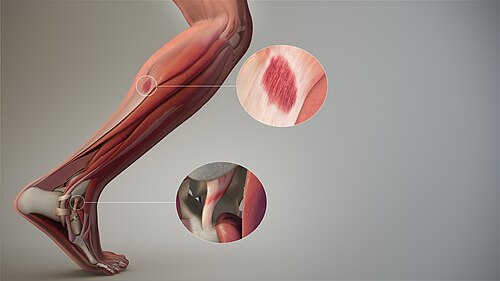sprain
