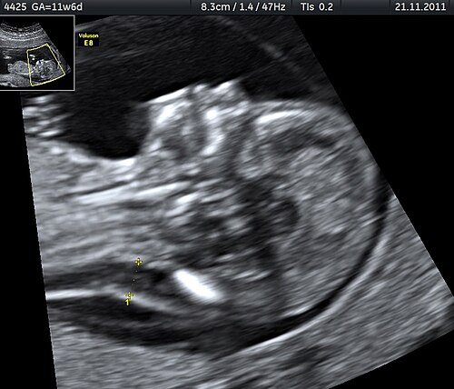 stillbirth
