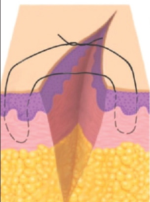 suture