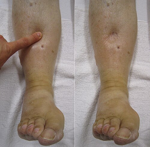 swollen