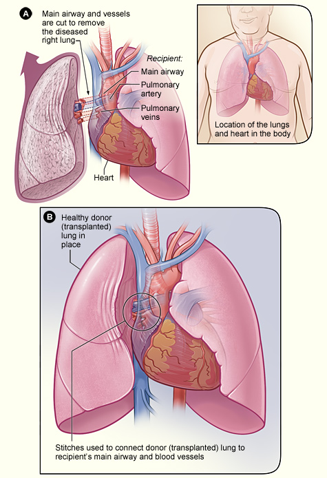 transplant