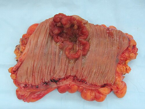 tumor